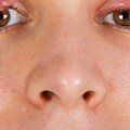 Do eyelash extensions cause chalazion?