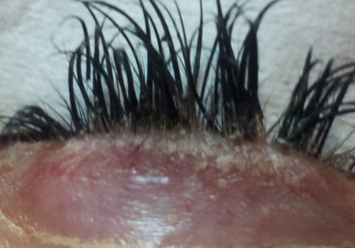 Are there any risks with eyelash extensions?
