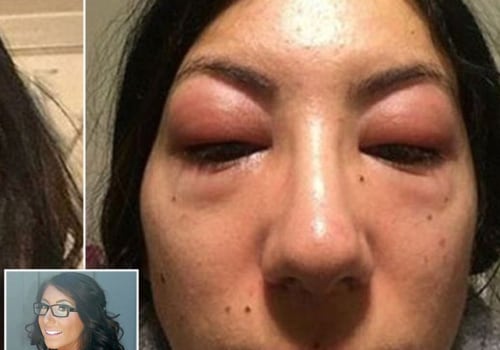 Can an allergy to lash extensions go away?